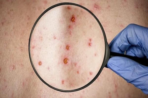 Viruela del mono: experto de la OMS alertó que la enfermedad podría declararse pronto como pandemia