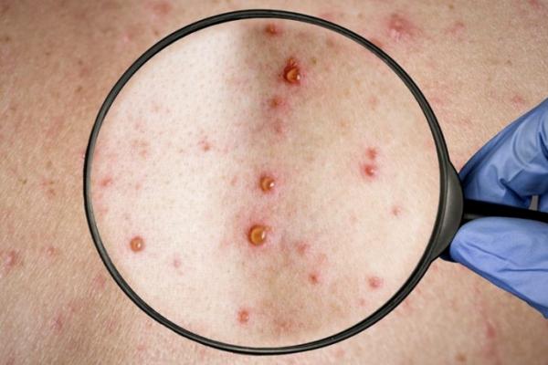 Viruela del mono: la OMS la declaró "emergencia sanitaria internacional"